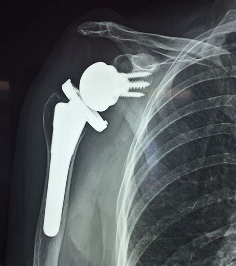 Reverse Shoulder Arthroplasty .